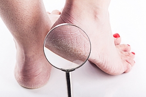 Pregnancy and Cracked Heels