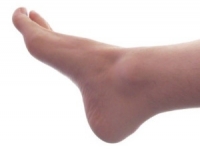 A Common Cause of Cuboid Syndrome